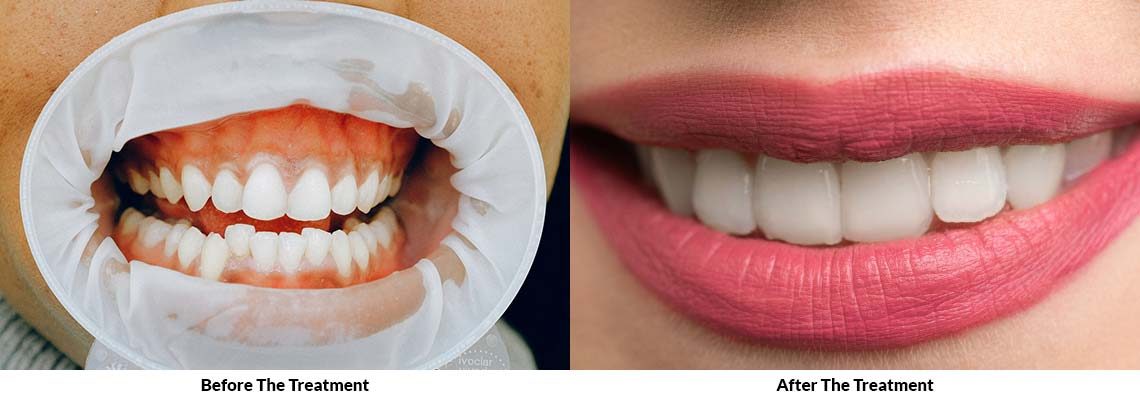 Treatment-Tab-Pictures-Of-Before-After-1140x400
